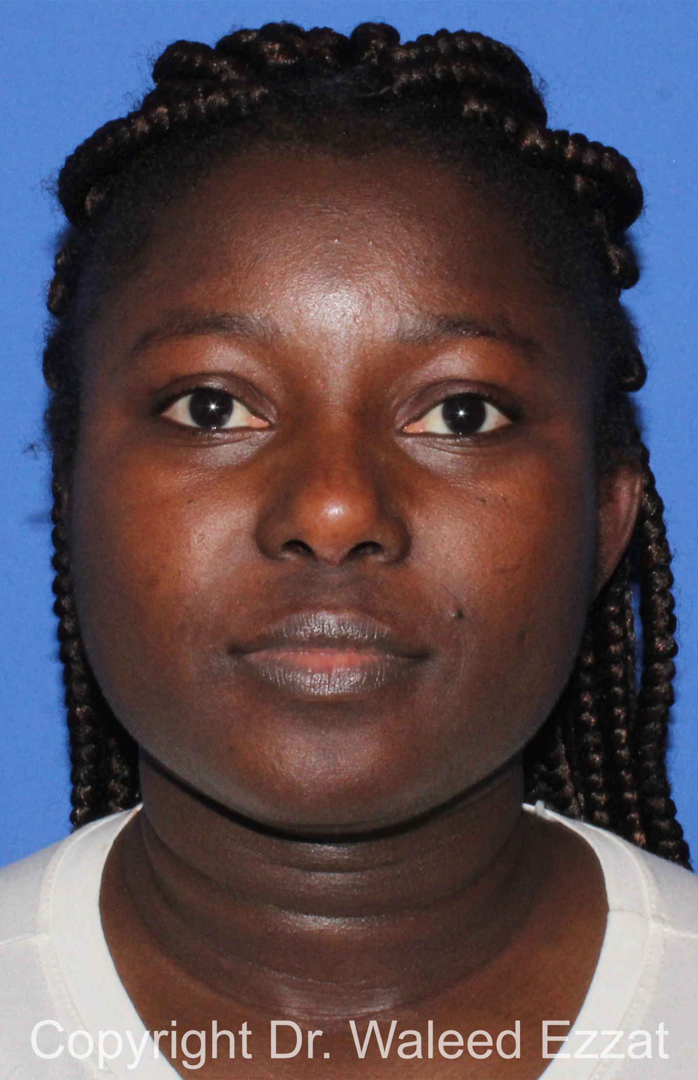 African/Caribbean Rhinoplasty Patient Photo - Case 204 - after view-2