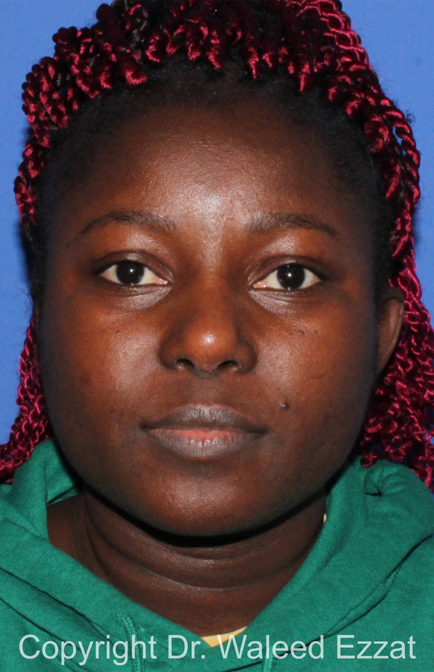 African/Caribbean Rhinoplasty Patient Photo - Case 206 - after view-2