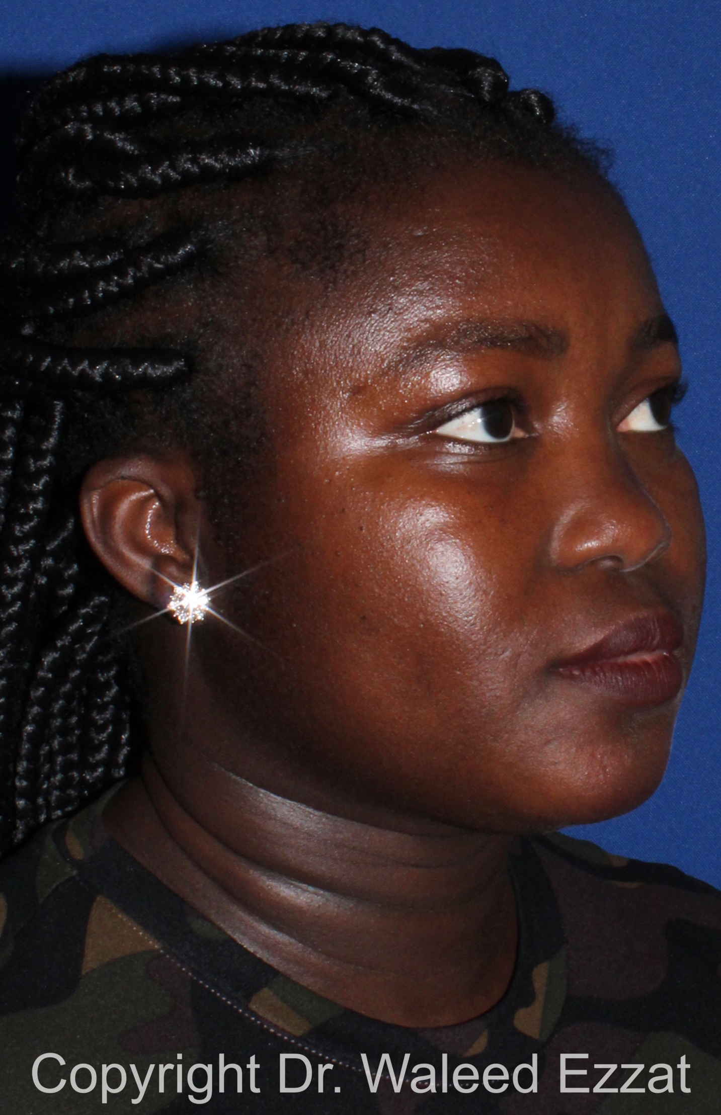African/Caribbean Rhinoplasty Patient Photo - Case 206 - before view-1