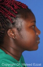 African/Caribbean Rhinoplasty - Case 206 - After