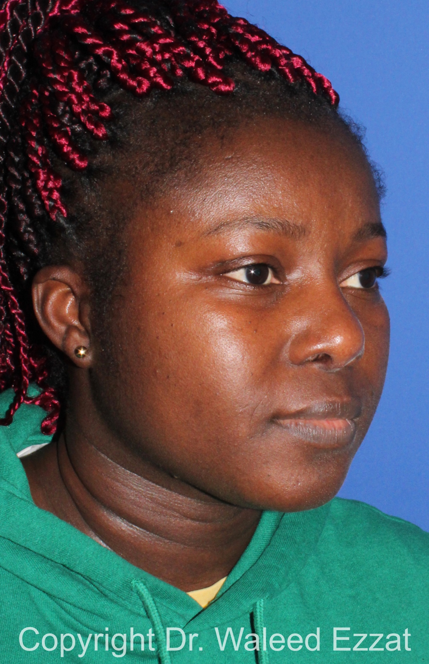 African/Caribbean Rhinoplasty Patient Photo - Case 206 - after view-1