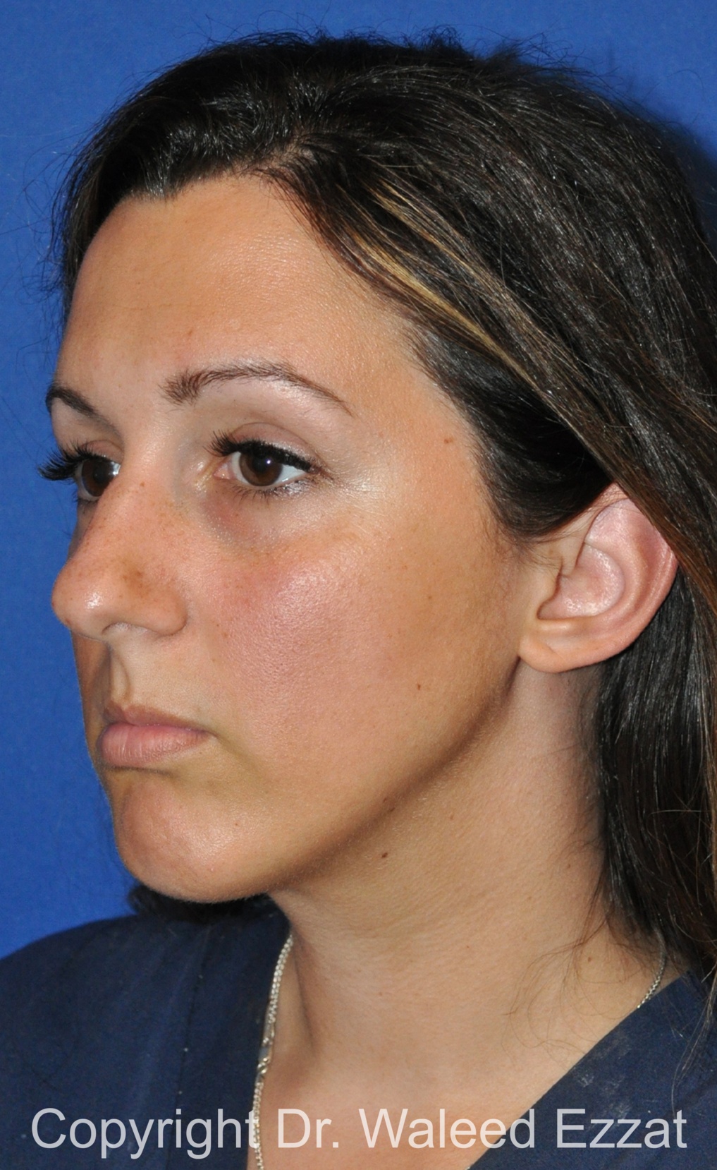 Caucasian/European Rhinoplasty Patient Photo - Case 33 - before view-1