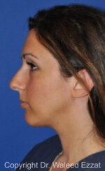 Caucasian/European Rhinoplasty - Case 33 - Before