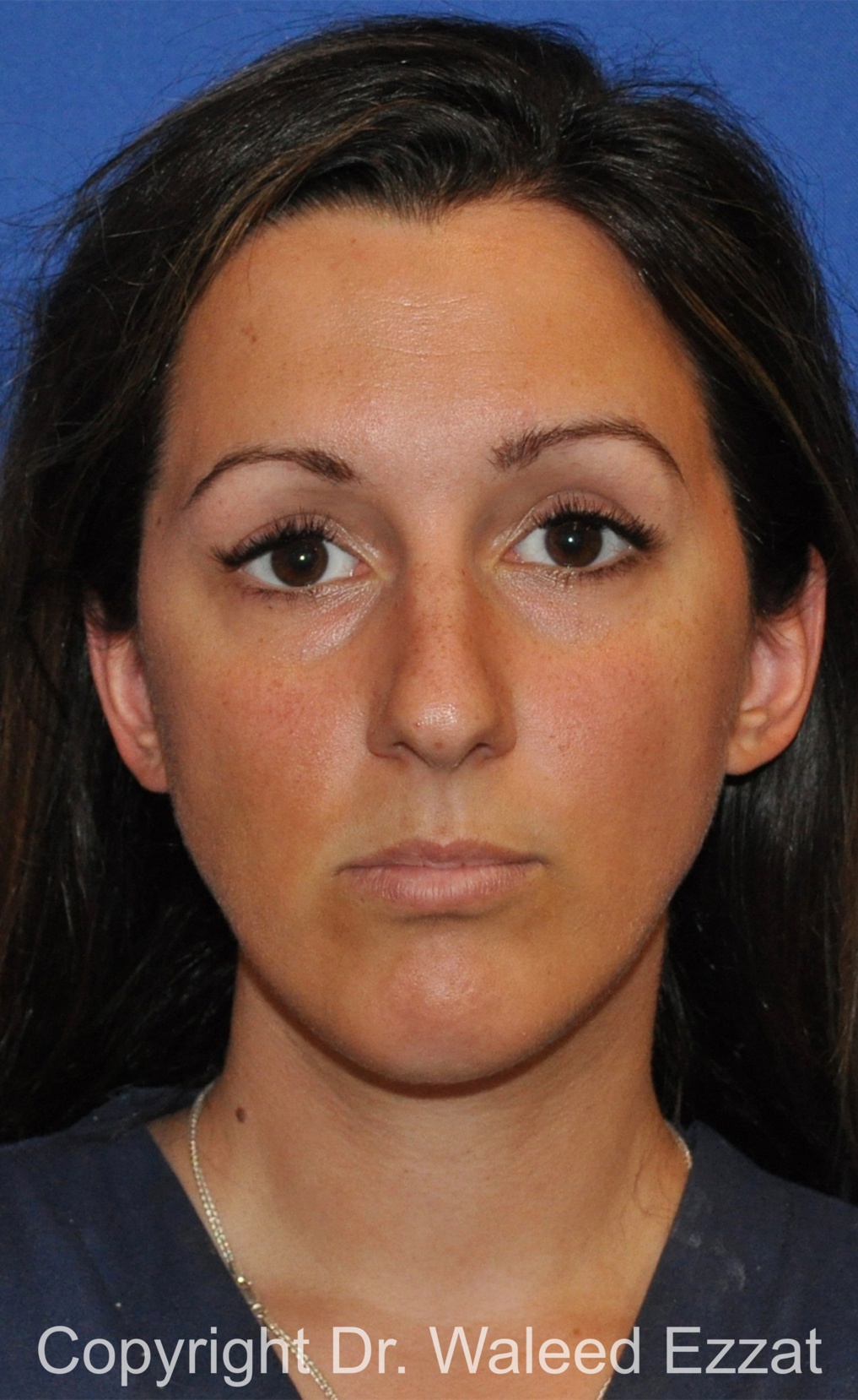 Caucasian/European Rhinoplasty Patient Photo - Case 33 - before view-2