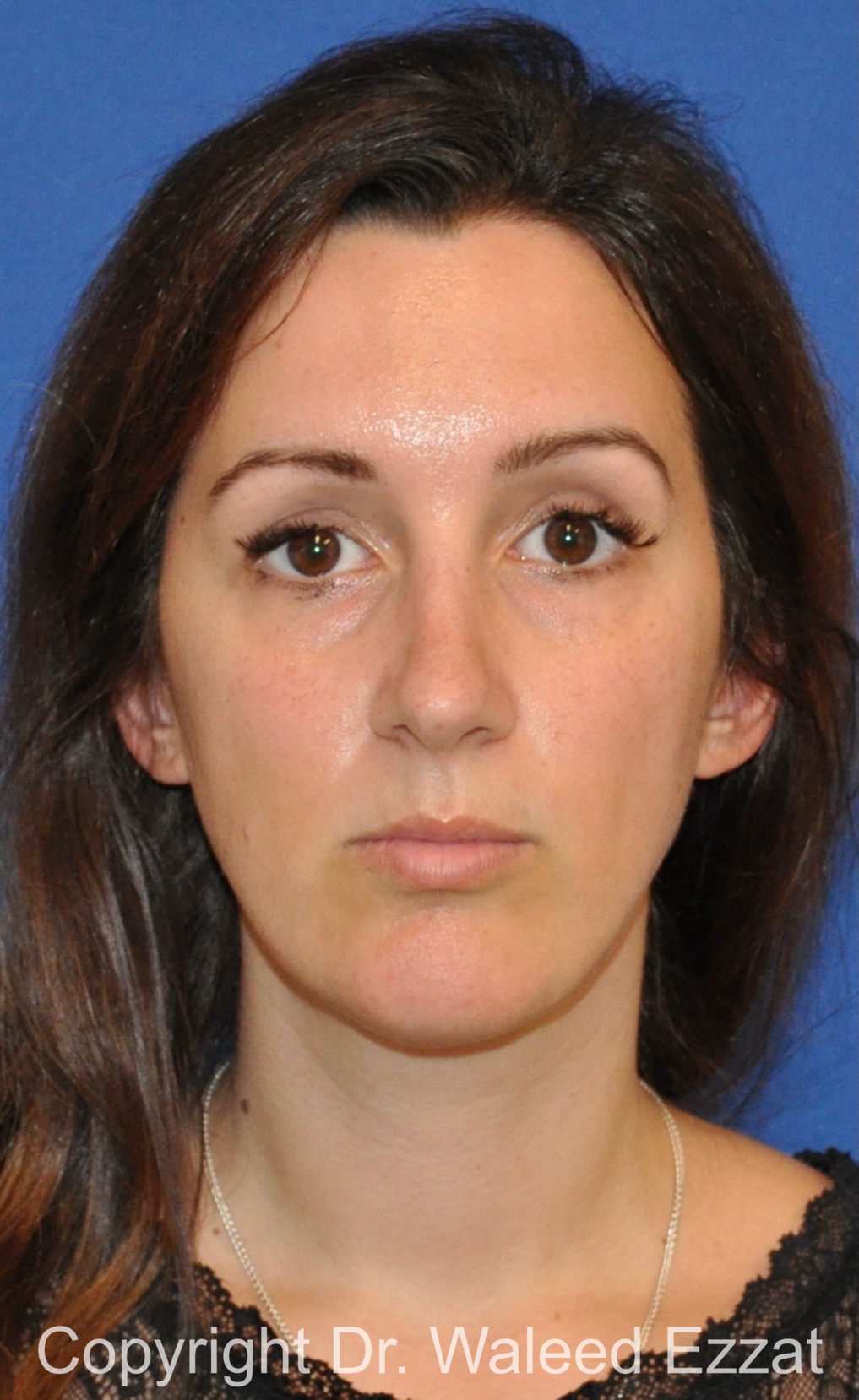 Caucasian/European Rhinoplasty Patient Photo - Case 33 - after view-2
