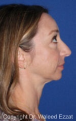 Caucasian/European Rhinoplasty - Case 34 - Before