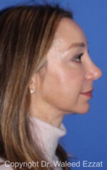 Caucasian/European Rhinoplasty - Case 34 - After