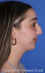 Caucasian/European Rhinoplasty - Case 35 - Before