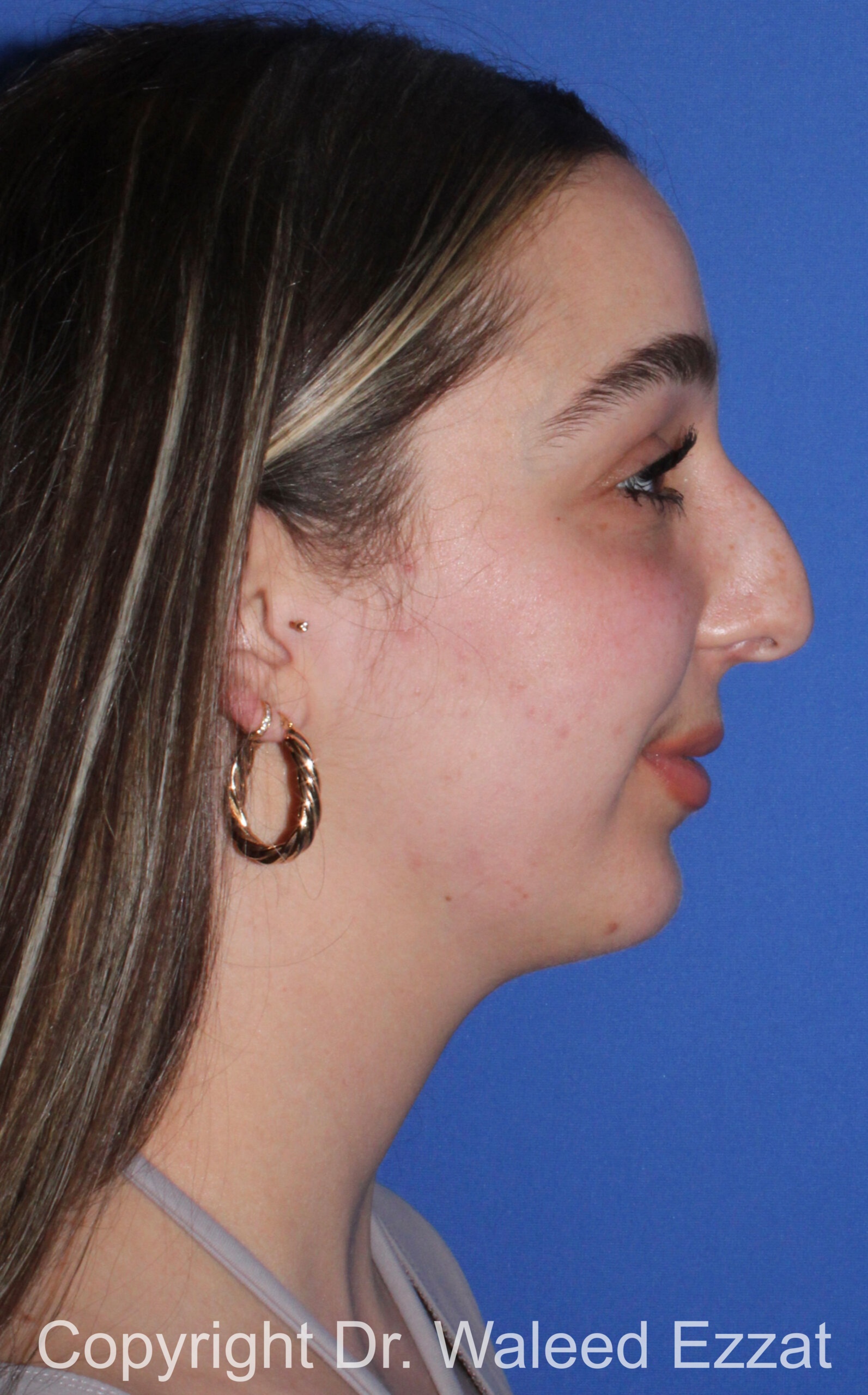 Caucasian/European Rhinoplasty Patient Photo - Case 35 - before view-