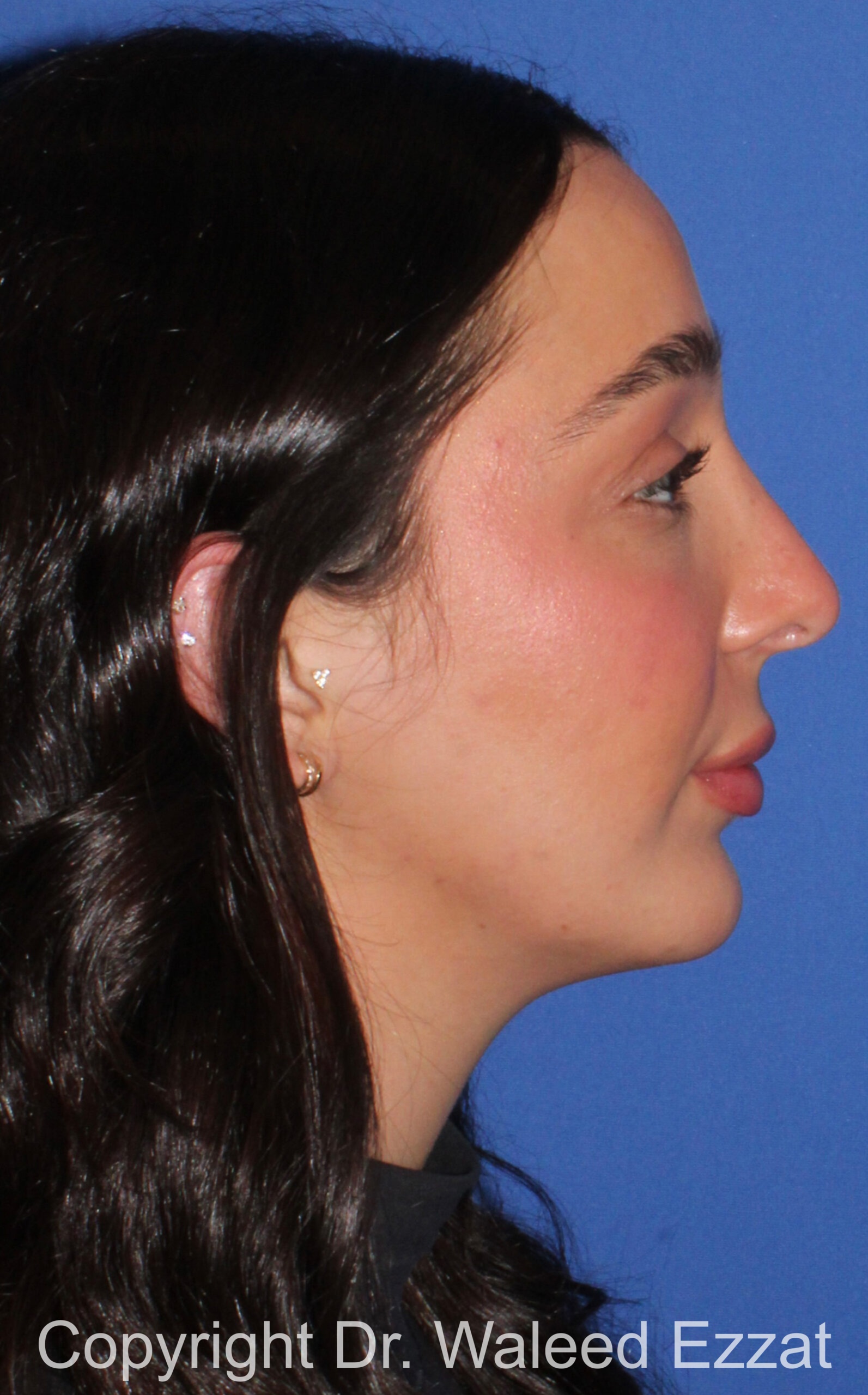 Caucasian/European Rhinoplasty Patient Photo - Case 35 - after view