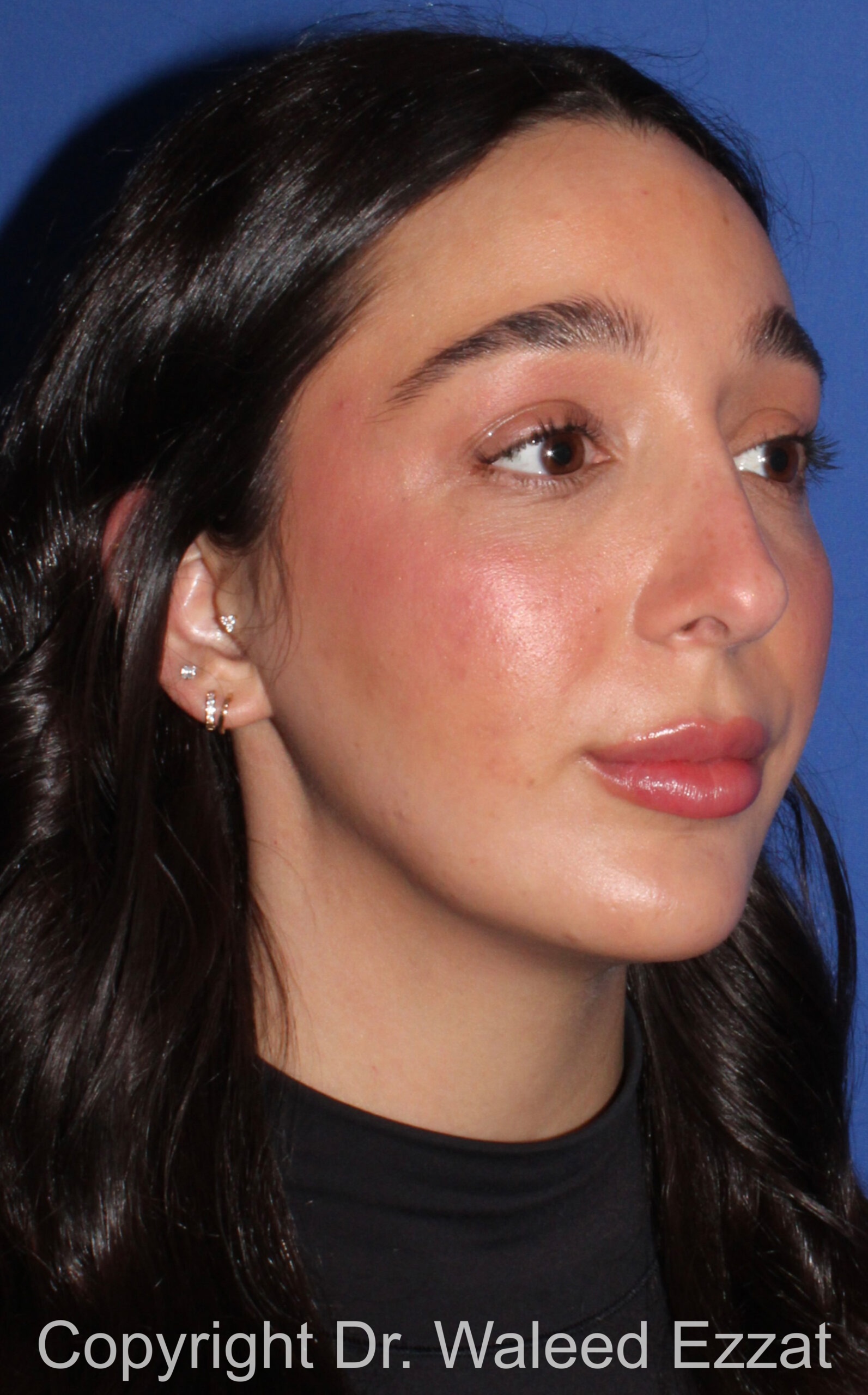 Caucasian/European Rhinoplasty Patient Photo - Case 35 - after view-1