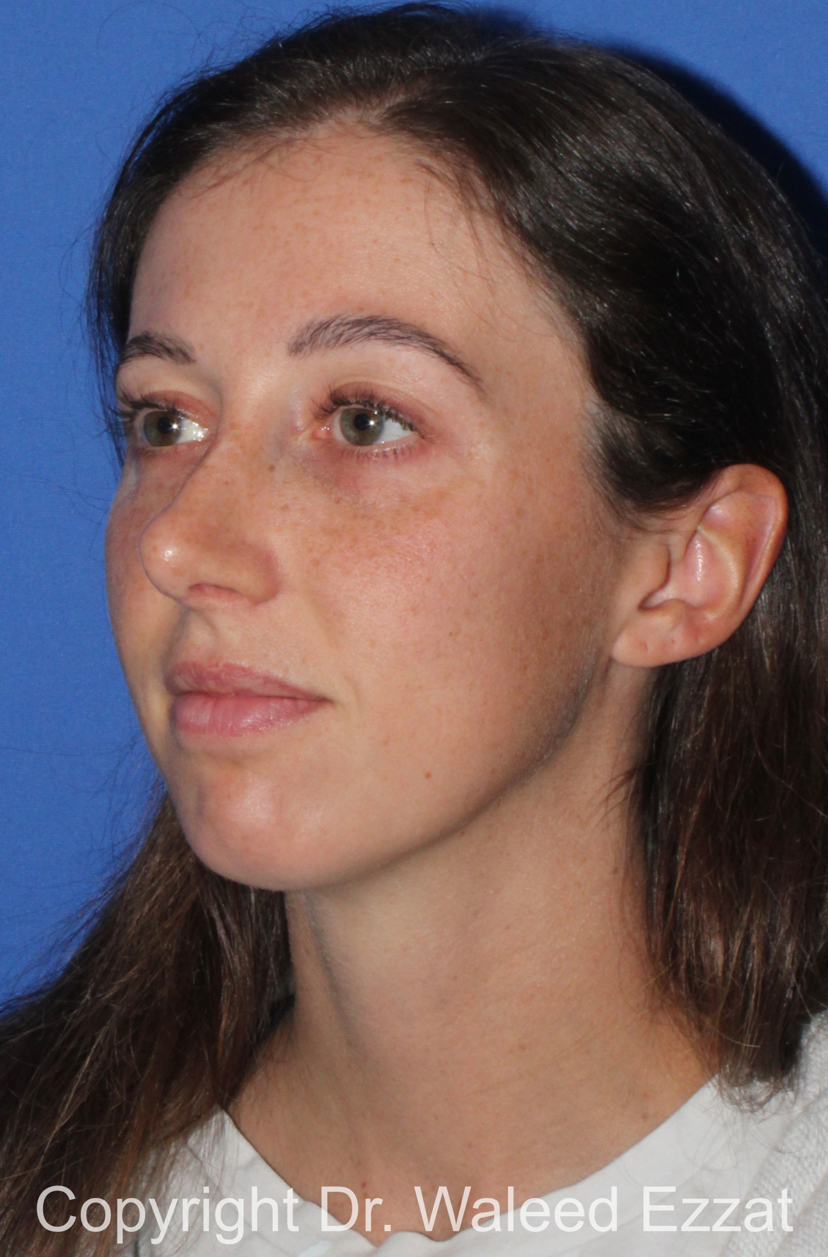 Caucasian/European Rhinoplasty Patient Photo - Case 36 - after view-1