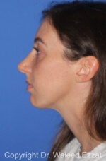 Caucasian/European Rhinoplasty - Case 36 - After