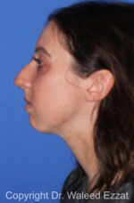 Caucasian/European Rhinoplasty - Case 36 - Before