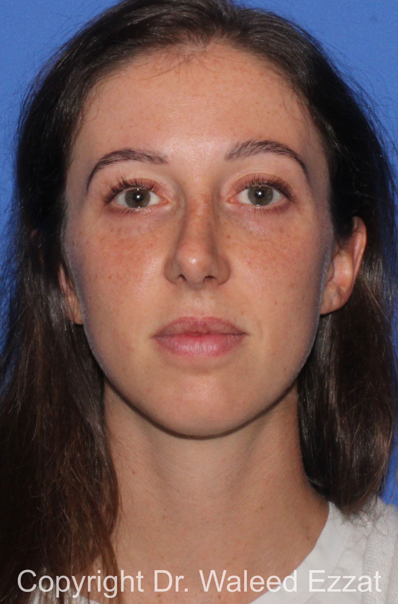 Caucasian/European Rhinoplasty Patient Photo - Case 36 - after view-2