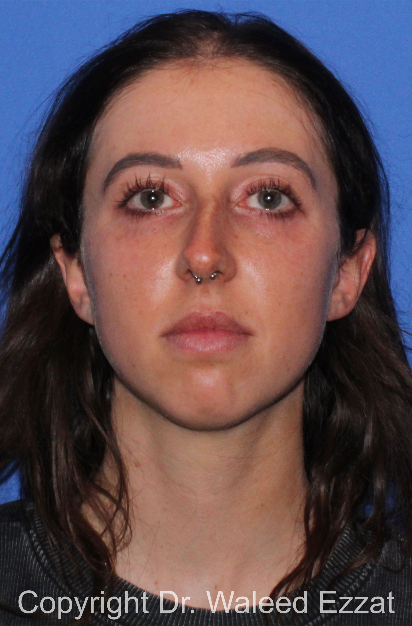 Caucasian/European Rhinoplasty Patient Photo - Case 36 - before view-2