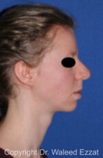Caucasian/European Rhinoplasty - Case 38 - Before