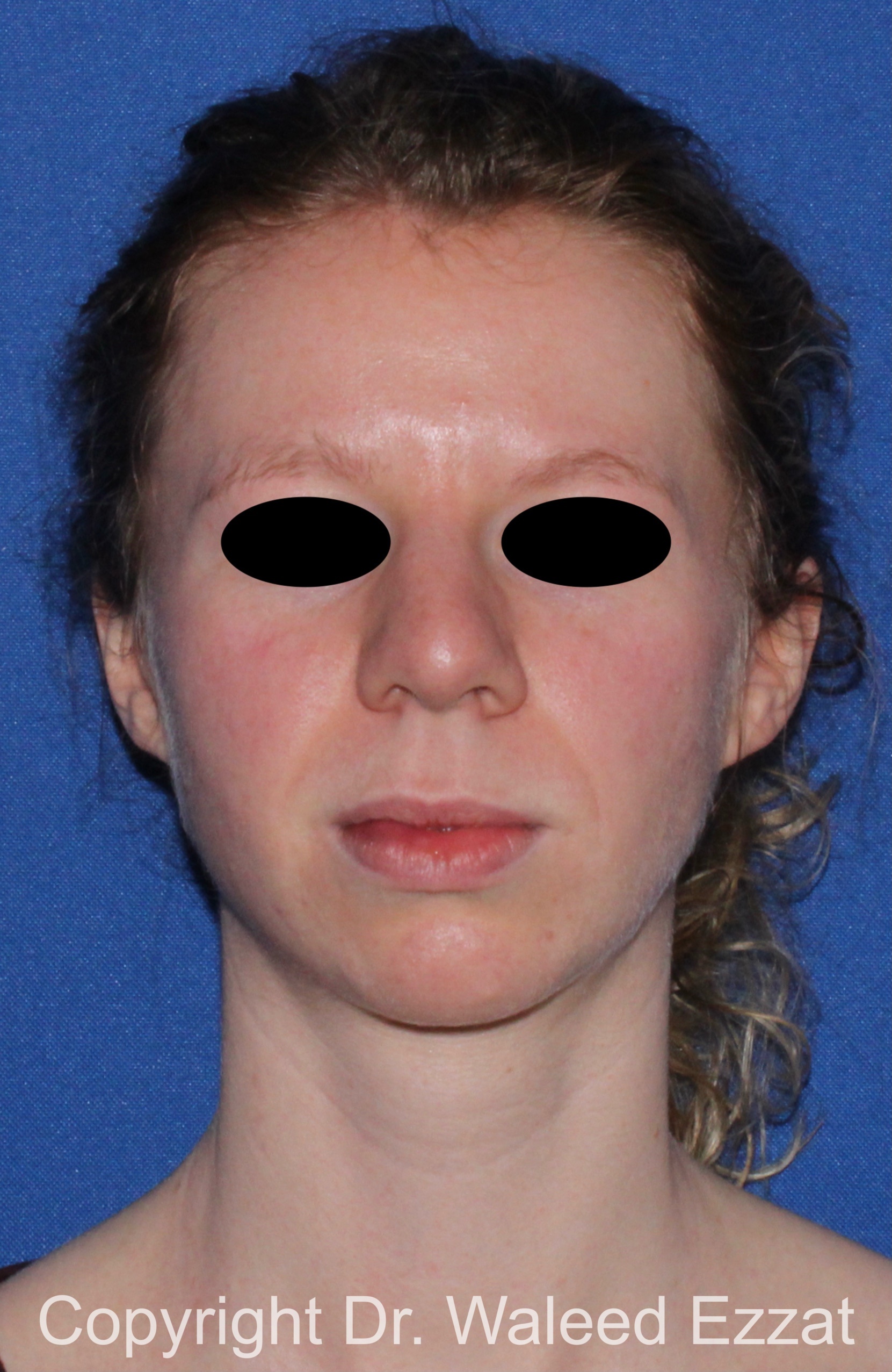 Caucasian/European Rhinoplasty Patient Photo - Case 38 - before view-2