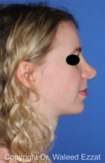 Caucasian/European Rhinoplasty - Case 38 - After