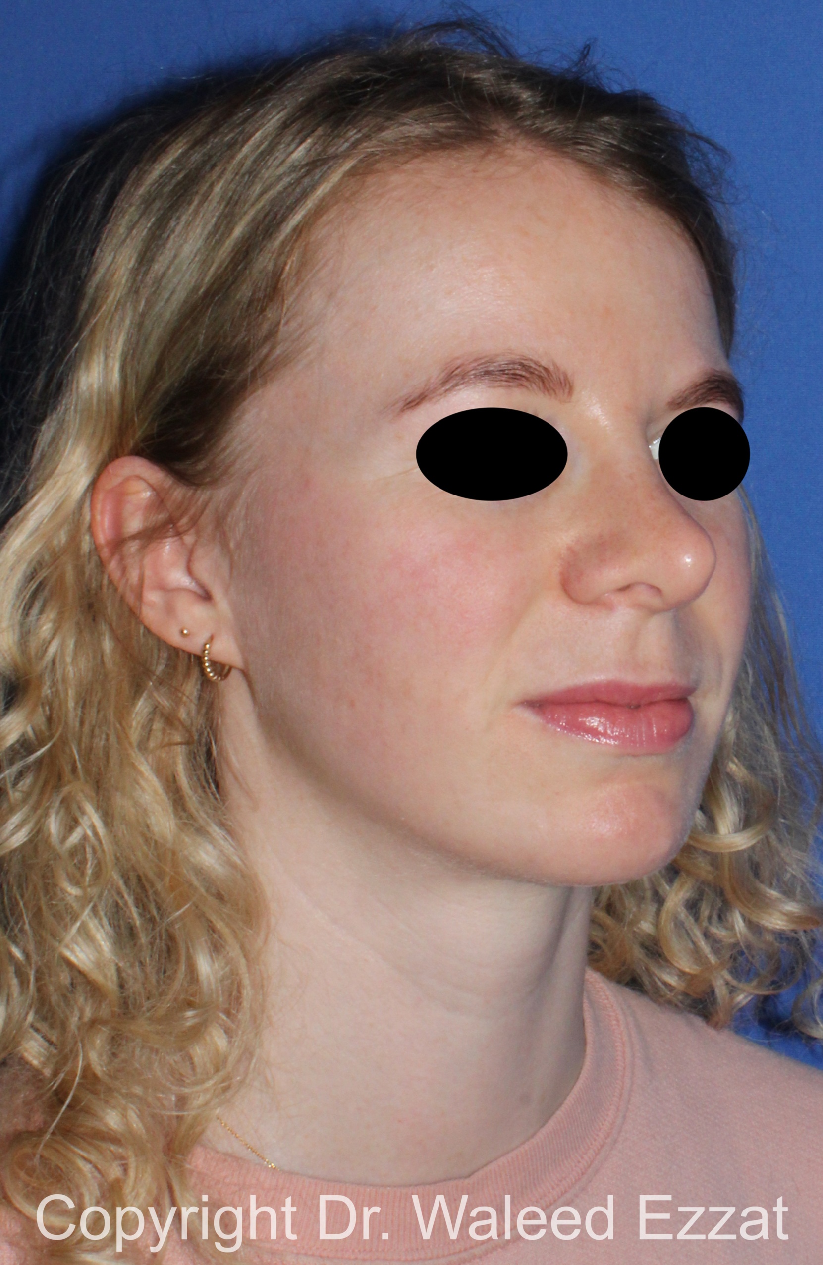 Caucasian/European Rhinoplasty Patient Photo - Case 38 - after view-1