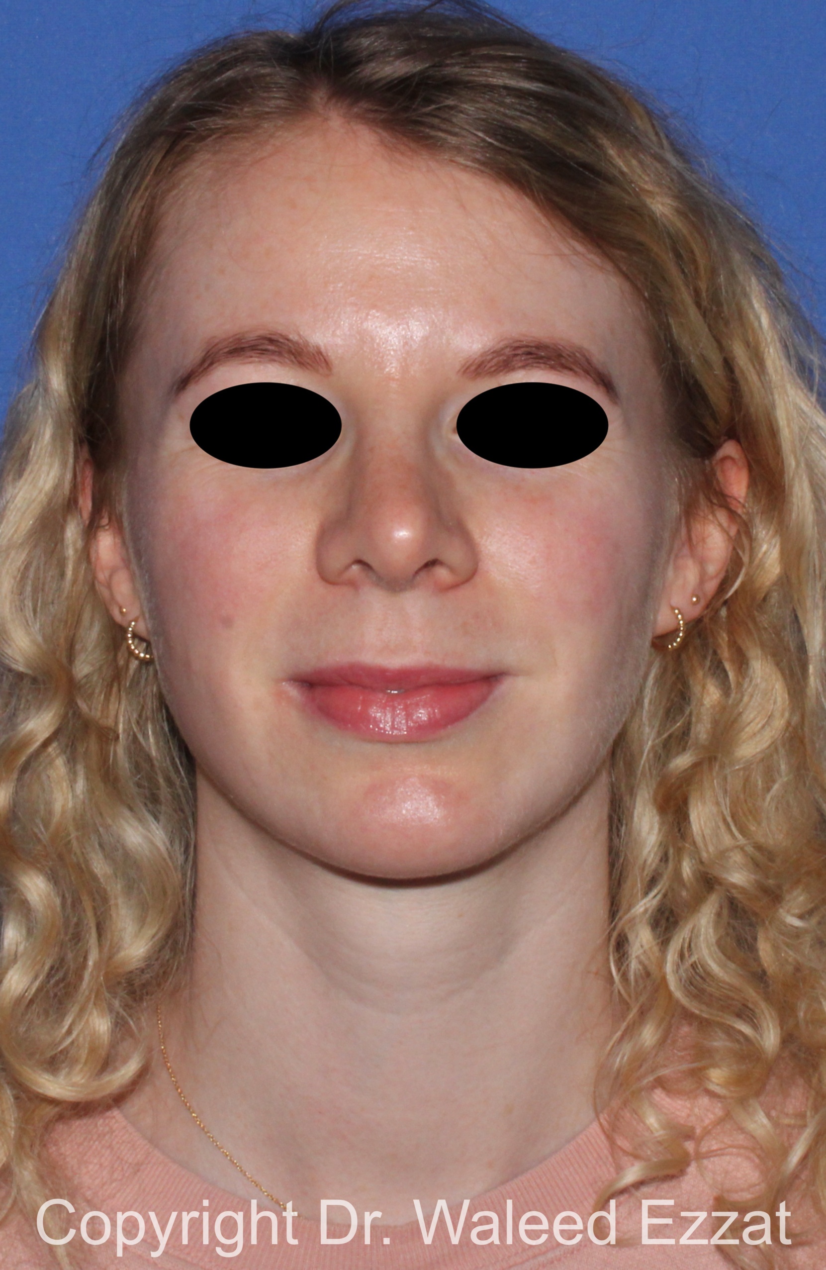 Caucasian/European Rhinoplasty Patient Photo - Case 38 - after view-2
