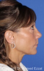 Caucasian/European Rhinoplasty - Case 80 - After