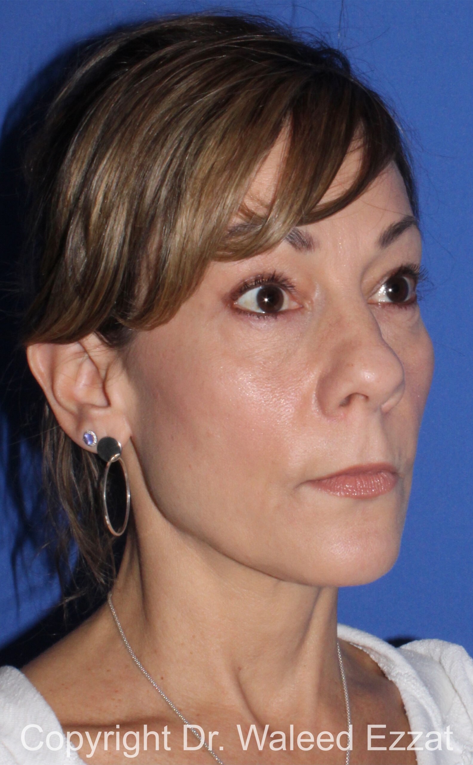 Caucasian/European Rhinoplasty Patient Photo - Case 80 - before view-1