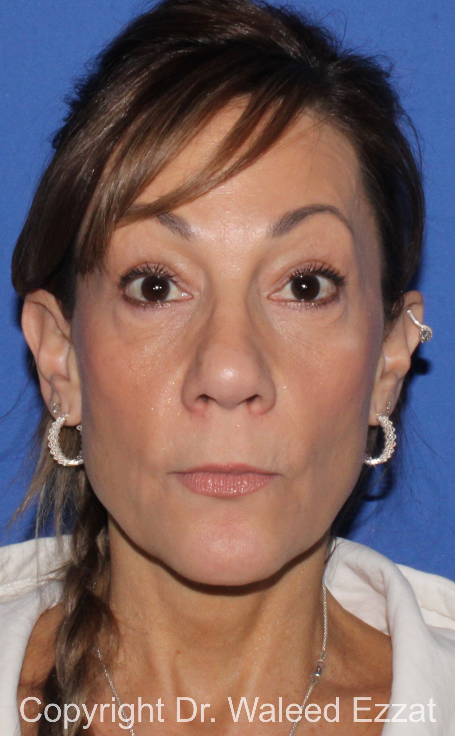 Caucasian/European Rhinoplasty Patient Photo - Case 80 - after view-2