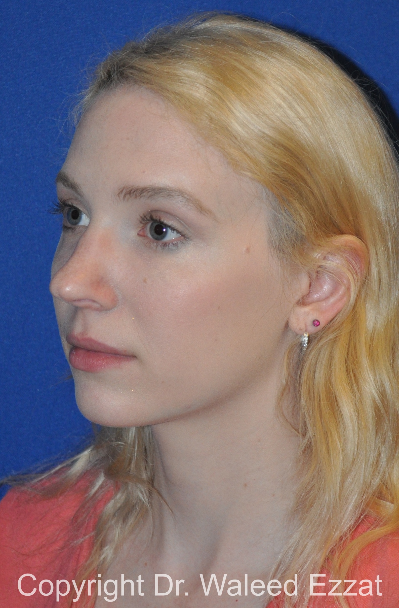 Caucasian/European Rhinoplasty Patient Photo - Case 85 - before view-1