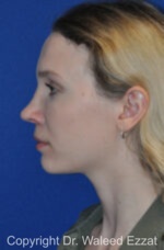 Caucasian/European Rhinoplasty - Case 85 - After