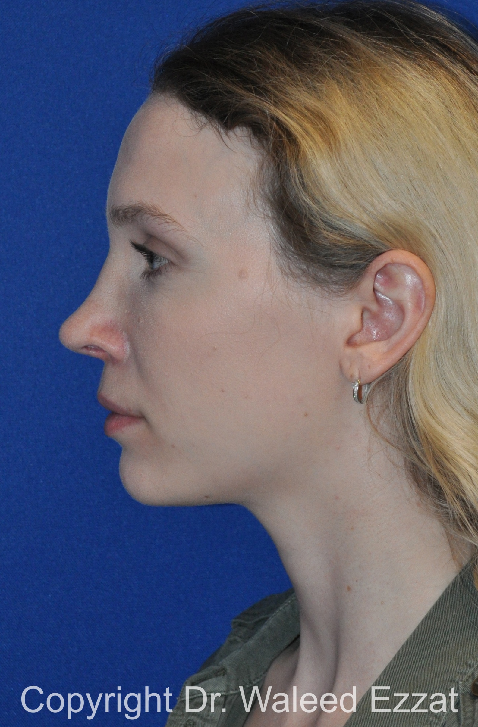 Caucasian/European Rhinoplasty Patient Photo - Case 85 - after view