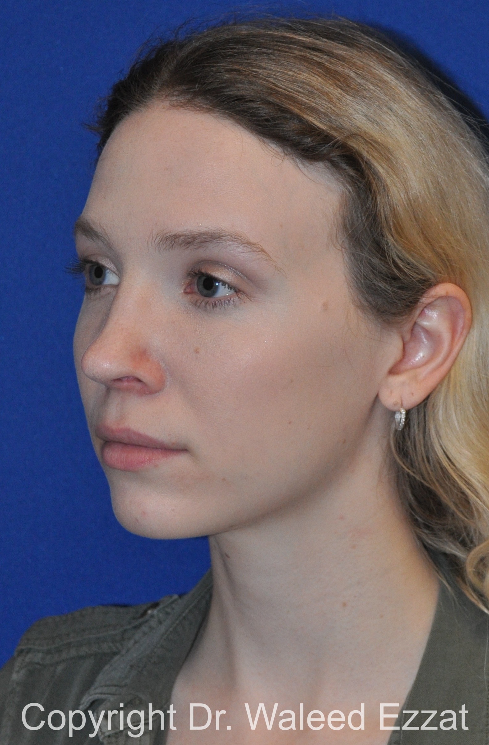 Caucasian/European Rhinoplasty Patient Photo - Case 85 - after view-1