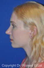 Caucasian/European Rhinoplasty - Case 85 - Before