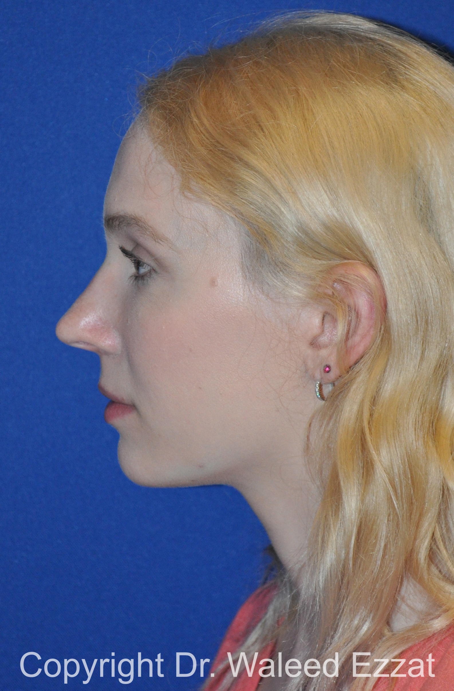 Caucasian/European Rhinoplasty Patient Photo - Case 85 - before view-
