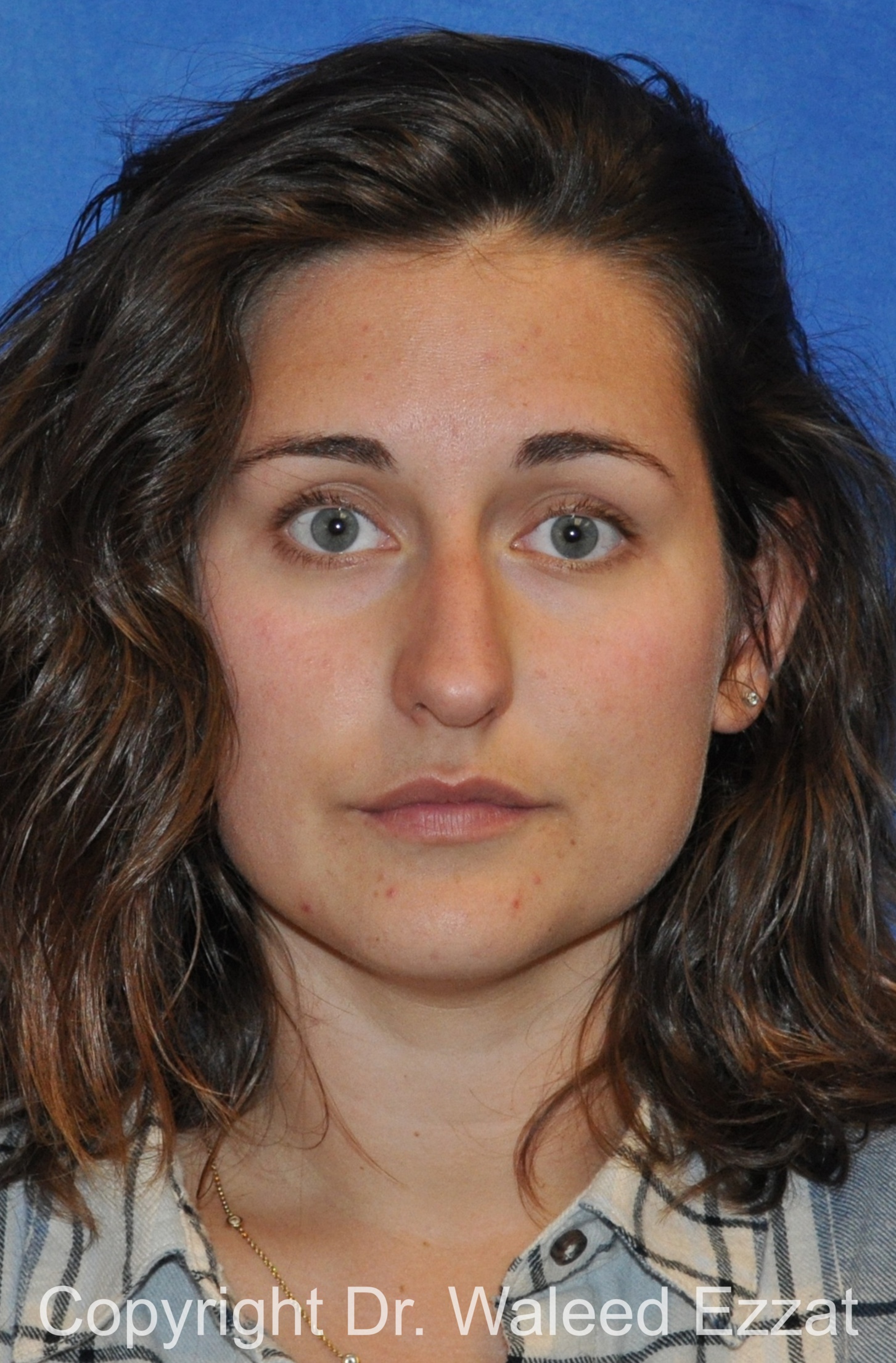 Rhinoplasty Patient Photo - Case 87 - before view-2