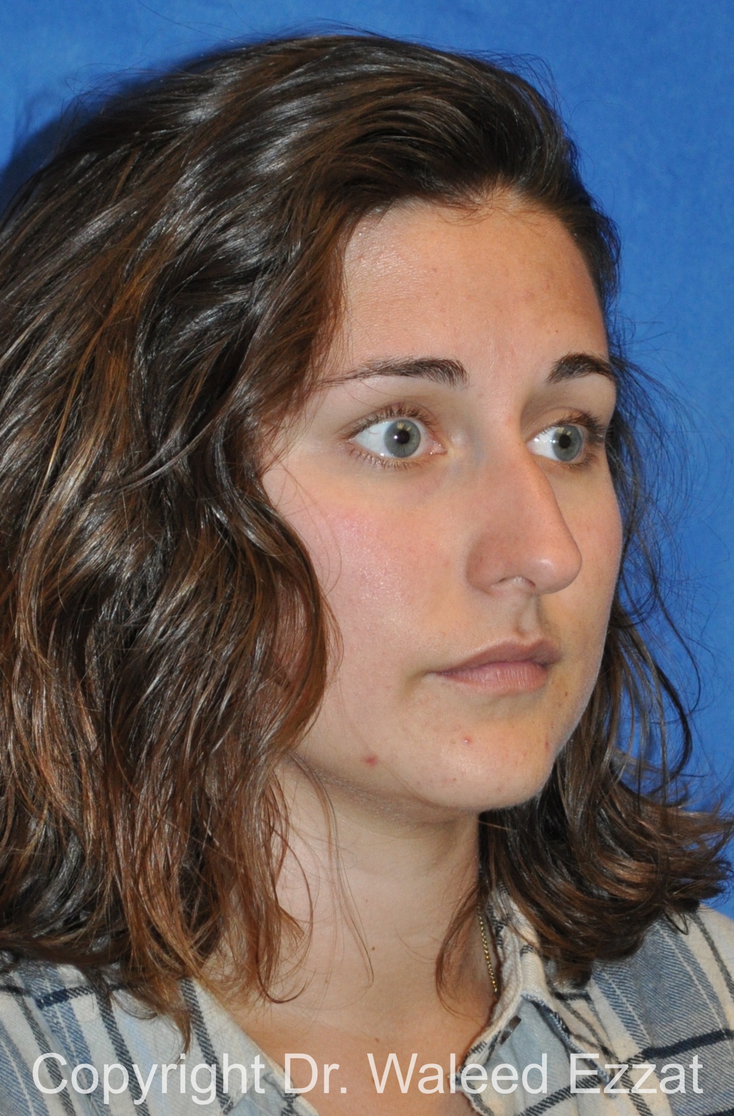 Rhinoplasty Patient Photo - Case 87 - before view-1