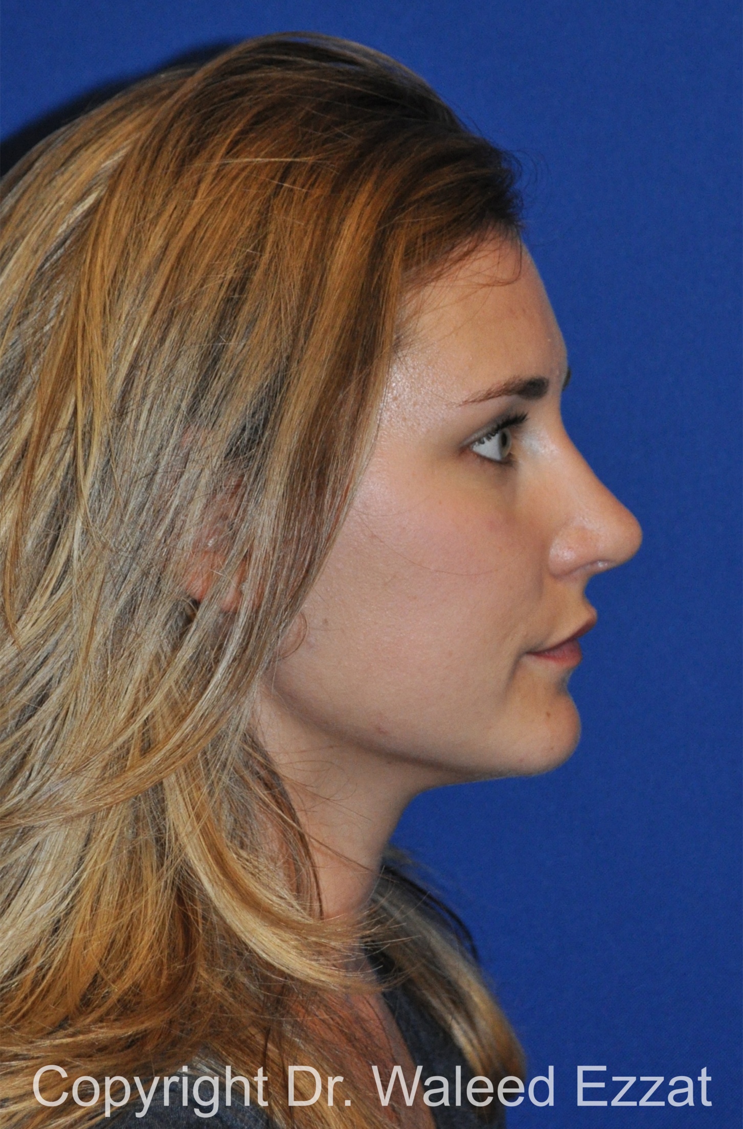 Rhinoplasty Patient Photo - Case 87 - after view
