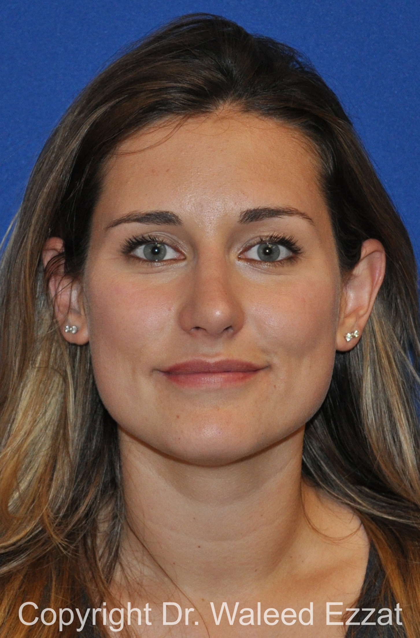 Rhinoplasty Patient Photo - Case 87 - after view-2