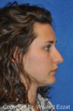 Caucasian/European Rhinoplasty - Case 87 - Before