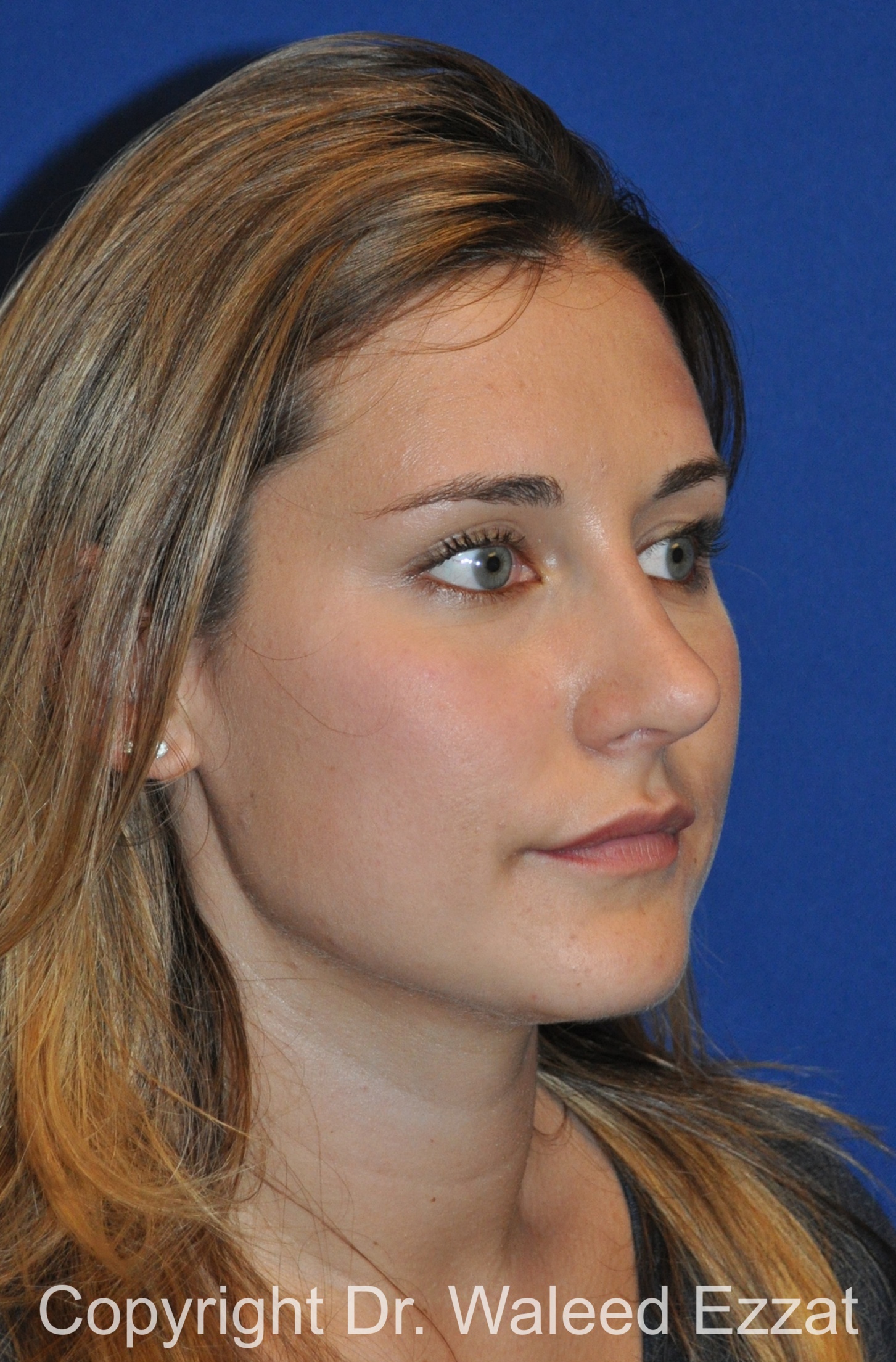 Rhinoplasty Patient Photo - Case 87 - after view-1