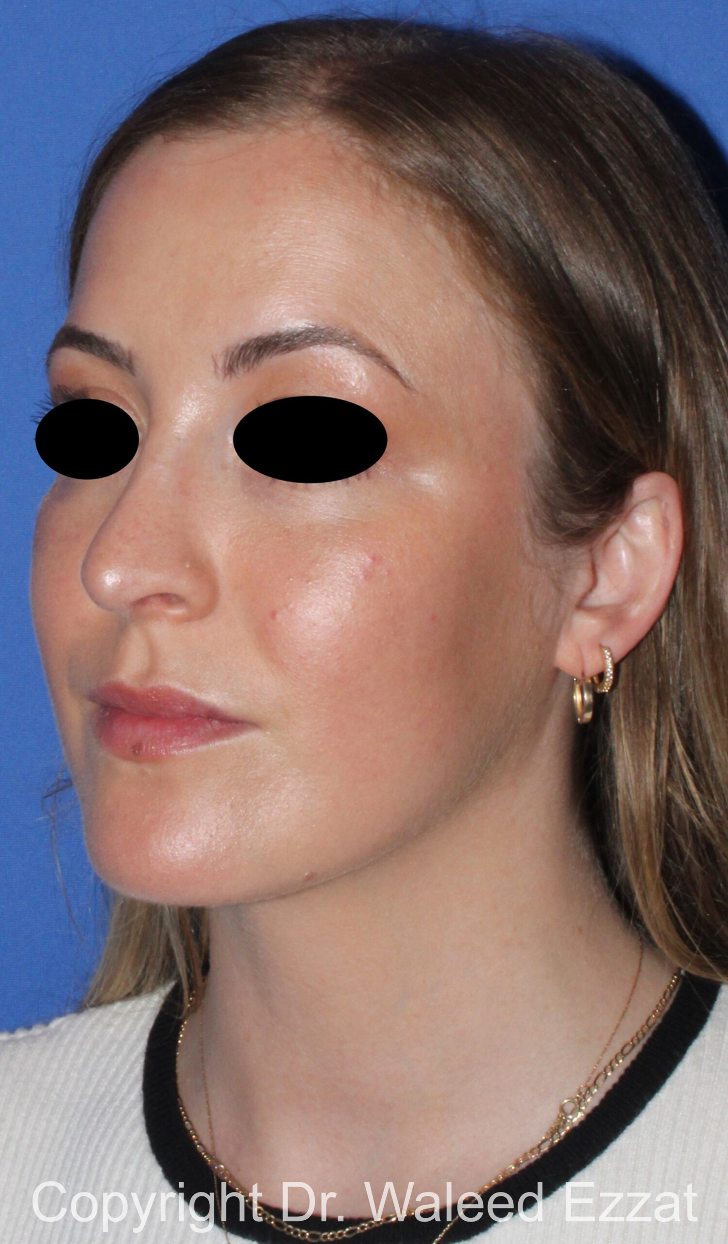 Rhinoplasty Patient Photo - Case 89 - after view-1