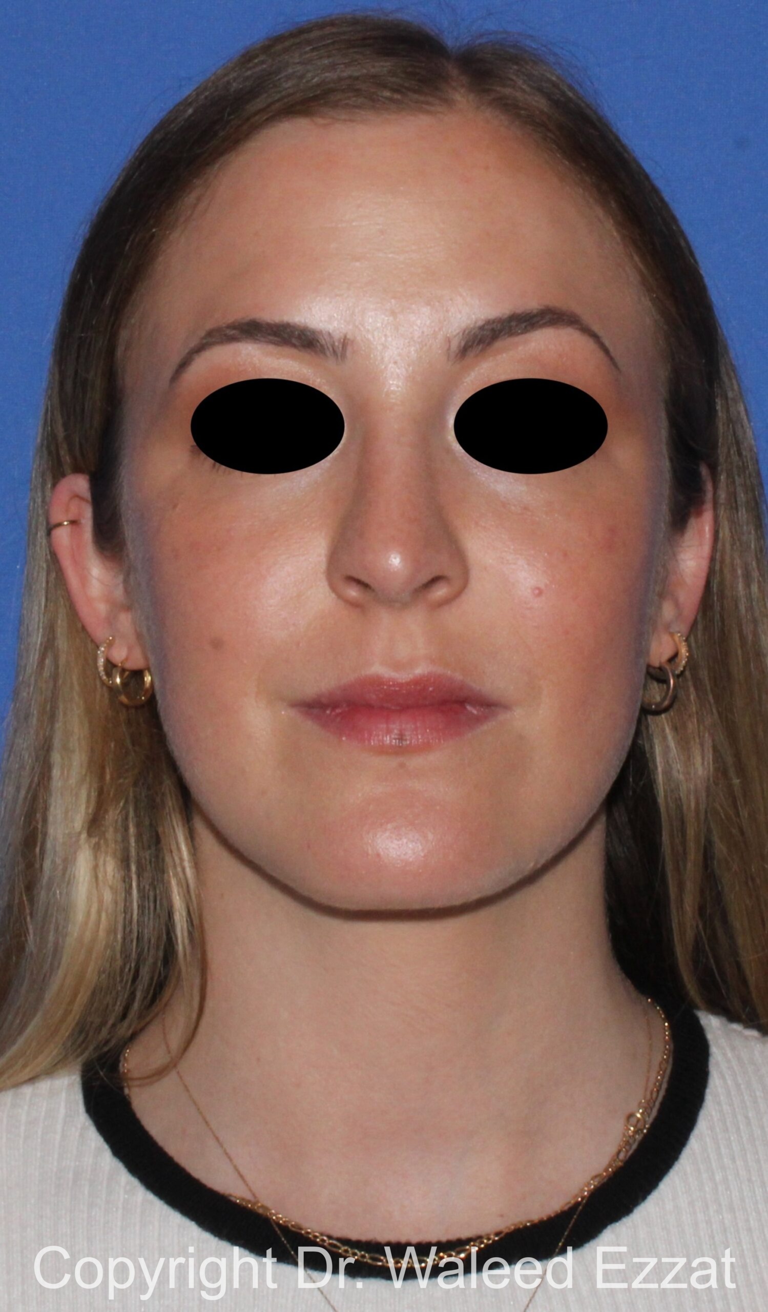 Rhinoplasty Patient Photo - Case 89 - after view-2