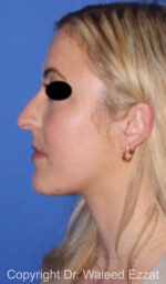 Caucasian/European Rhinoplasty - Case 89 - Before