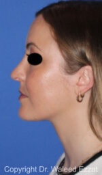 Caucasian/European Rhinoplasty - Case 89 - After