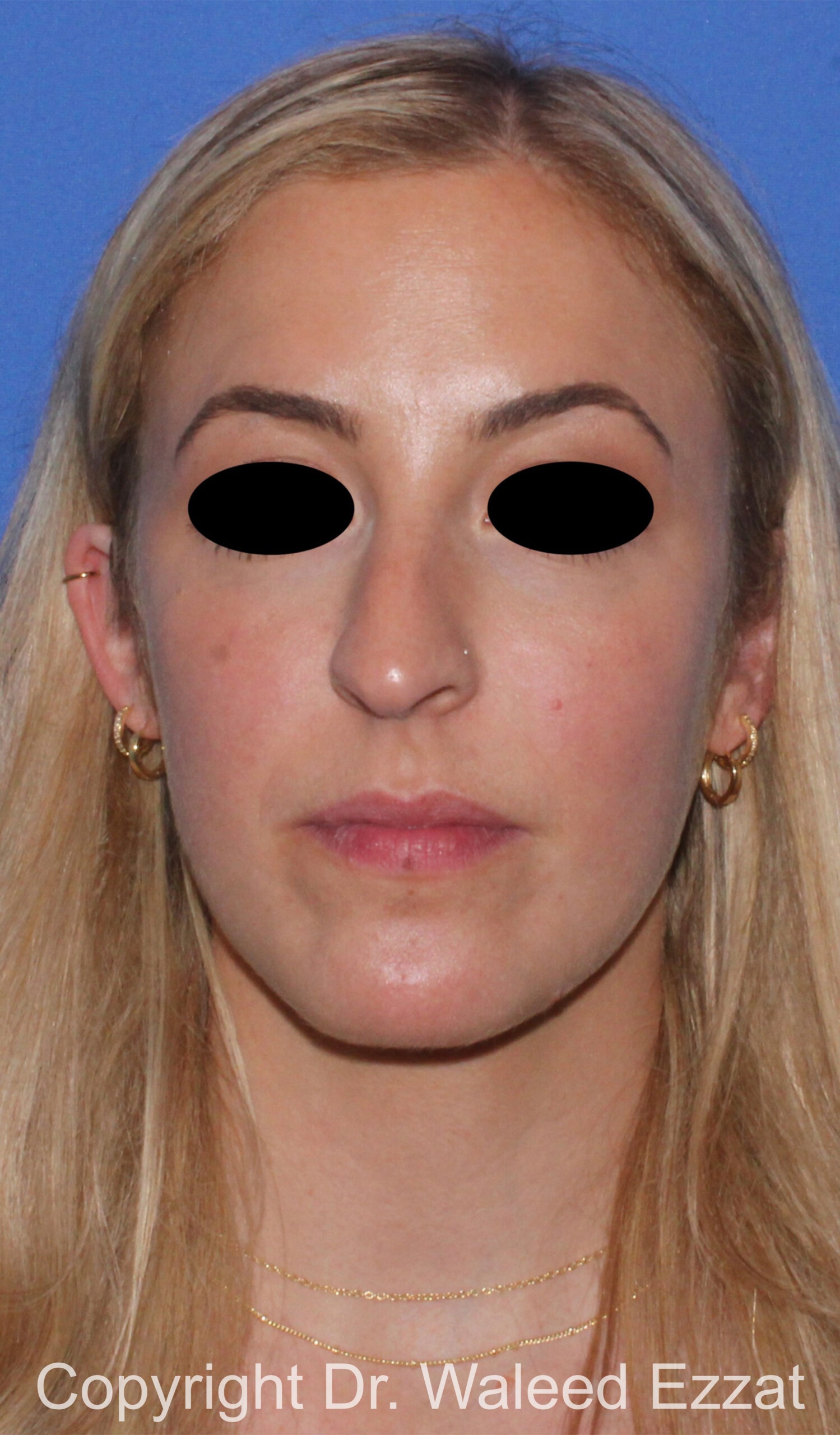 Rhinoplasty Patient Photo - Case 89 - before view-2