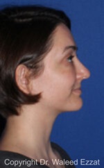 Caucasian/European Rhinoplasty - Case 92 - After