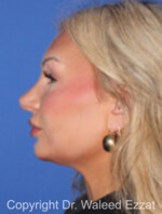 Caucasian/European Rhinoplasty - Case 93 - After