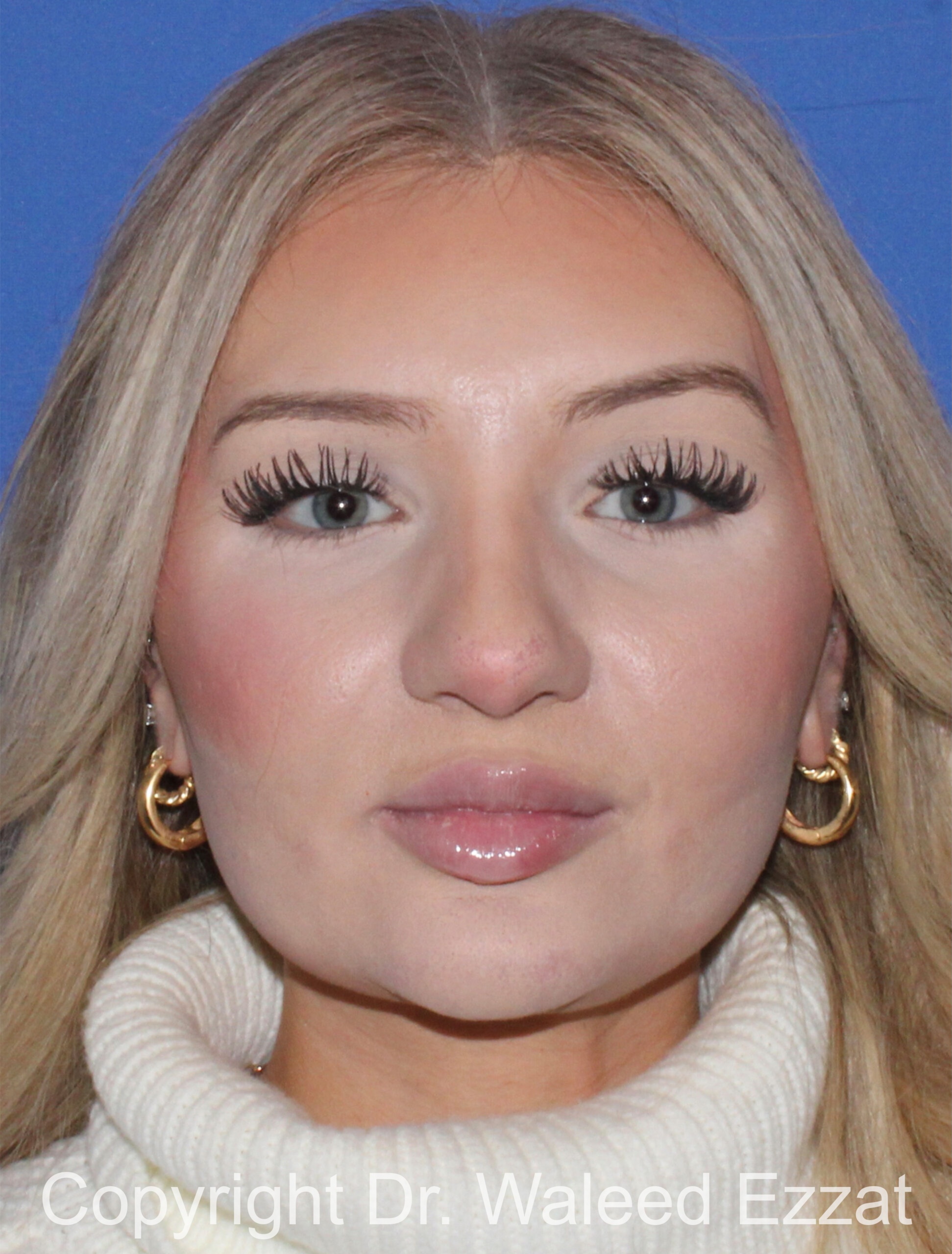 Rhinoplasty Patient Photo - Case 93 - before view-2