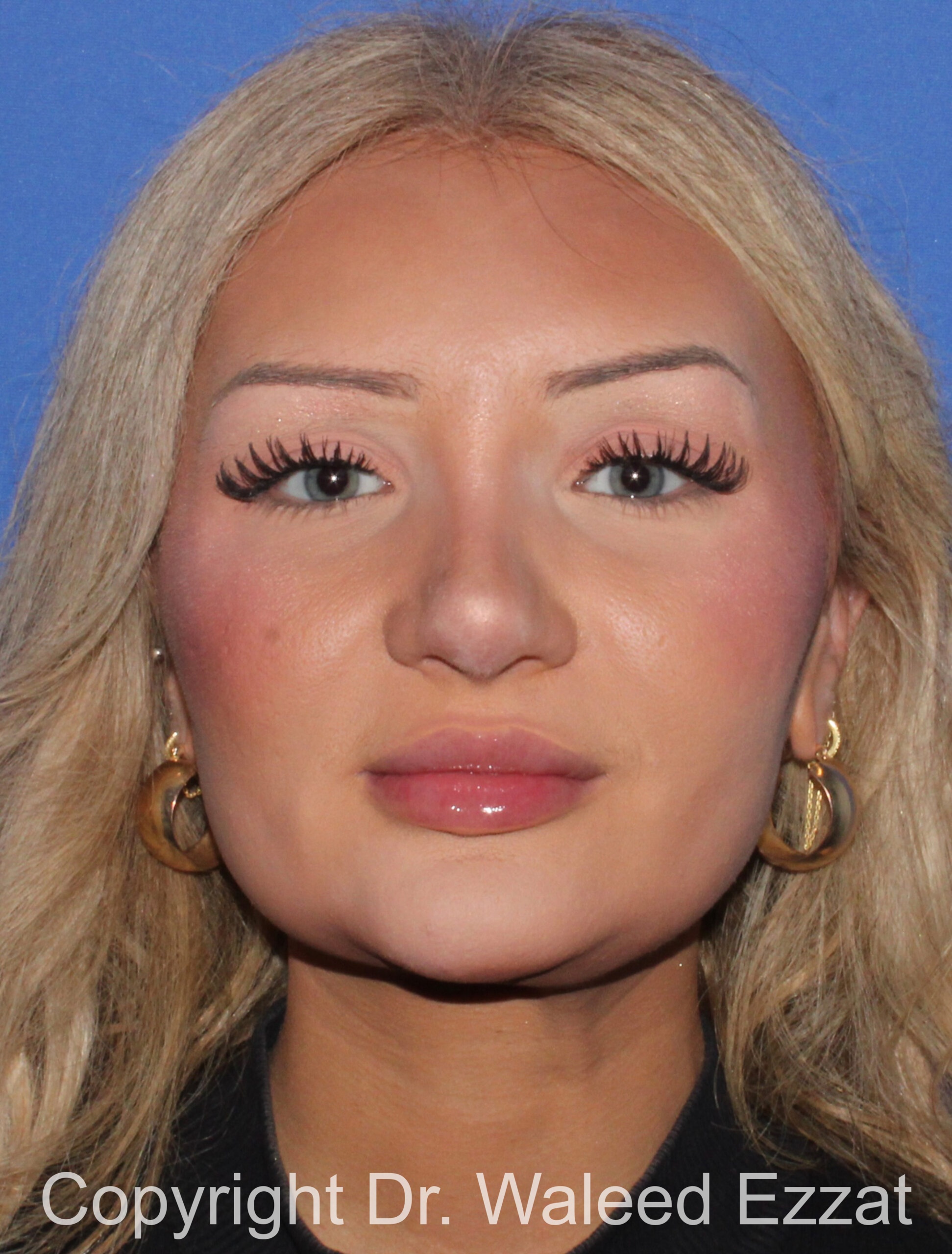 Rhinoplasty Patient Photo - Case 93 - after view-2