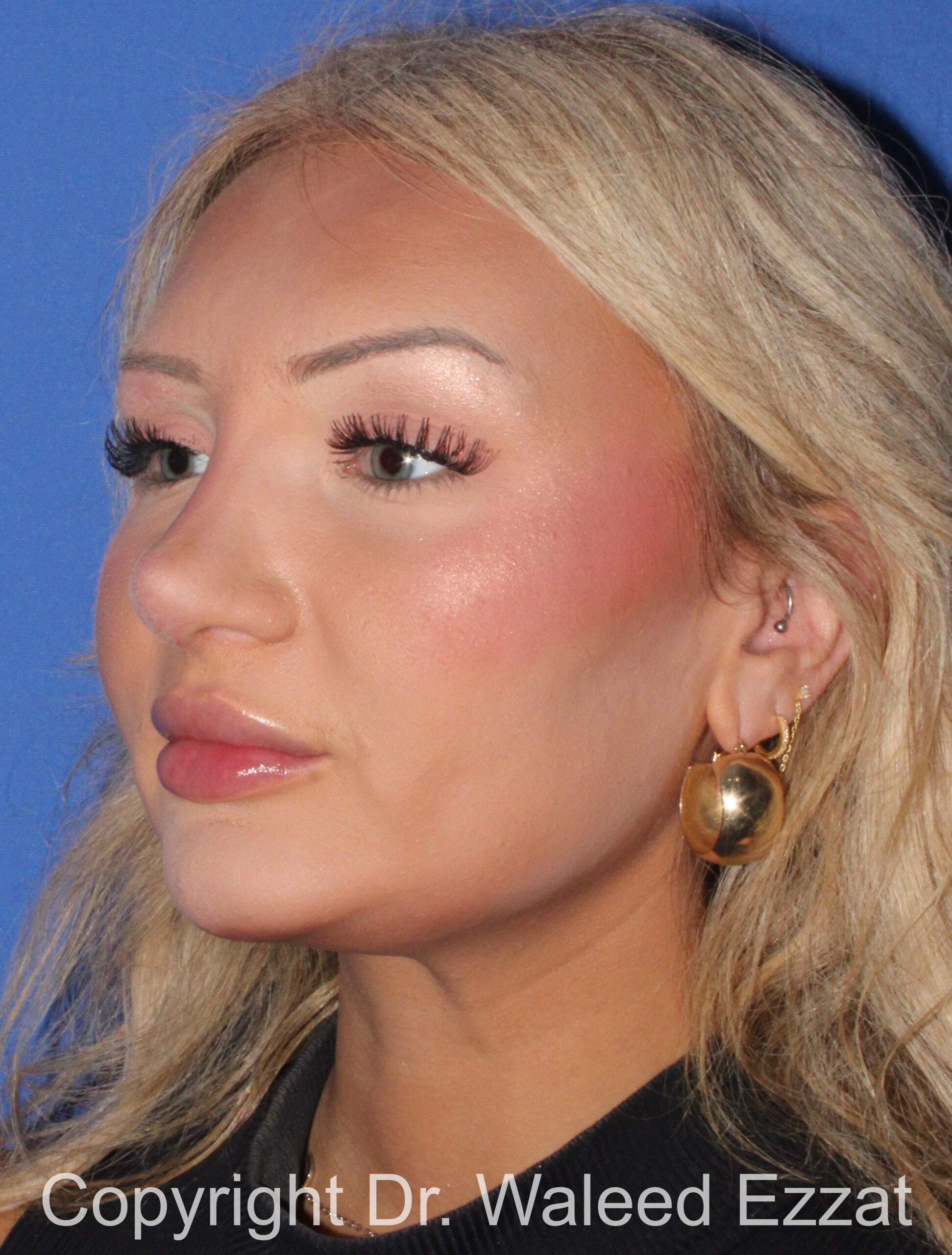 Rhinoplasty Patient Photo - Case 93 - after view-1